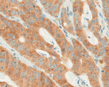 Image: Colorectal carcinoma positive with BRAF V600E (VE1) IHC with OptiView DAB IHC detection (Photo courtesy of Ventana).